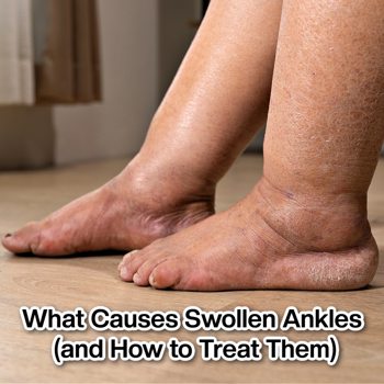 What Causes Swollen Ankles (and How to Treat Them) What Causes Swollen Ankles (and How to Treat Them)